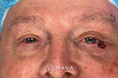 Mohs Reconstruction Before & After Gallery - Patient 376364 - Image 5