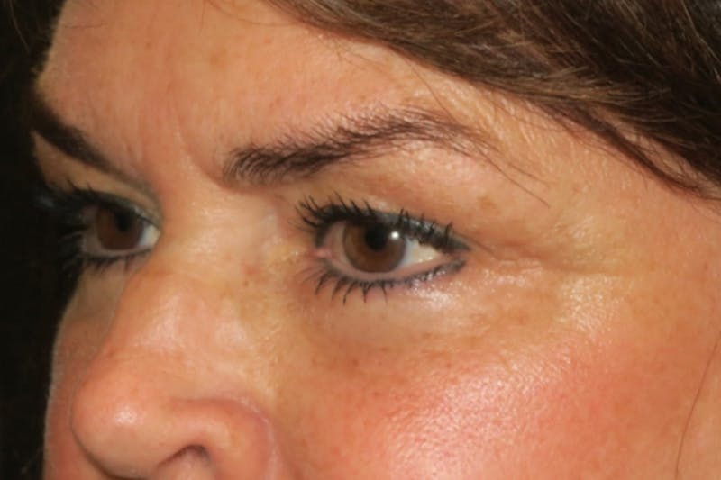 Ptosis Repair Before & After Gallery - Patient 424221 - Image 5