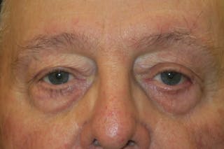 Mohs Reconstruction Before & After Gallery - Patient 376364 - Image 2