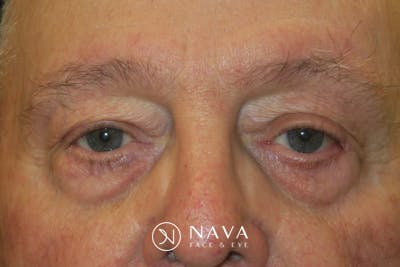 Mohs Reconstruction Before & After Gallery - Patient 376364 - Image 2