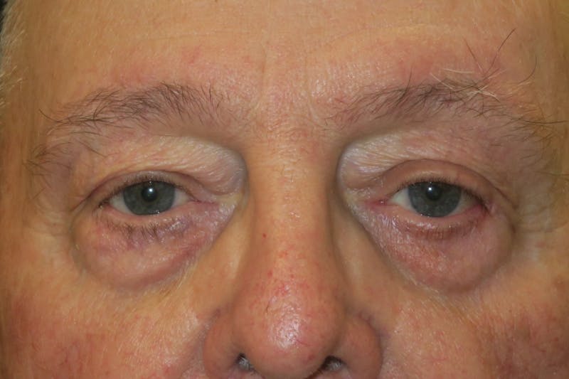 Mohs Reconstruction Before & After Gallery - Patient 404593 - Image 2