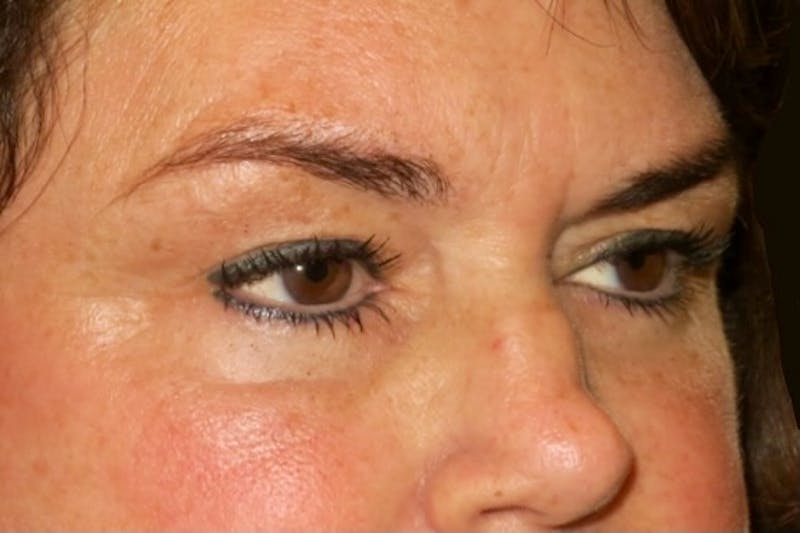 Ptosis Repair Before & After Gallery - Patient 424221 - Image 3
