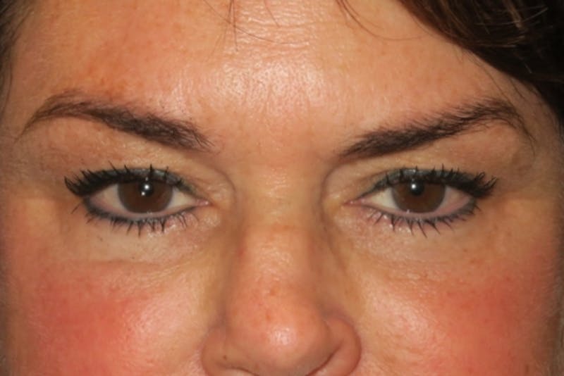Ptosis Repair Before & After Gallery - Patient 424221 - Image 1