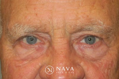 Upper Blepharoplasty (Upper Eyelid Surgery) Before & After Gallery - Patient 217597 - Image 4