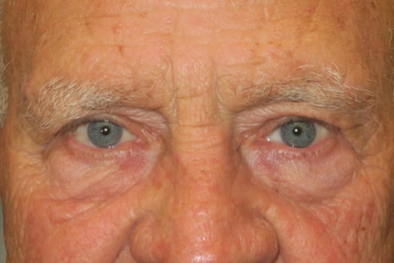 Browplasty (Brow Lift) Before & After Gallery - Patient 427788 - Image 2