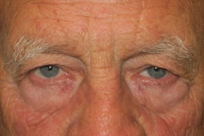 Upper Blepharoplasty (Upper Eyelid Surgery) Before & After Gallery - Patient 217597 - Image 1