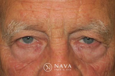 Upper Blepharoplasty (Upper Eyelid Surgery) Before & After Gallery - Patient 217597 - Image 1