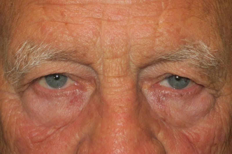 Upper Blepharoplasty (Upper Eyelid Surgery) Before & After Gallery - Patient 217597 - Image 1