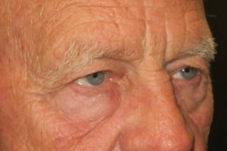 Upper Blepharoplasty (Upper Eyelid Surgery) Before & After Gallery - Patient 217597 - Image 2
