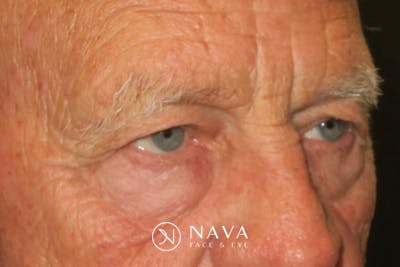 Upper Blepharoplasty (Upper Eyelid Surgery) Before & After Gallery - Patient 217597 - Image 2