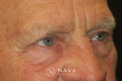 Upper Blepharoplasty (Upper Eyelid Surgery) Before & After Gallery - Patient 217597 - Image 5