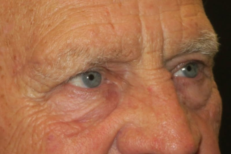 Upper Blepharoplasty (Upper Eyelid Surgery) Before & After Gallery - Patient 217597 - Image 5