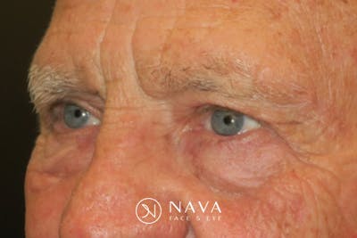 Upper Blepharoplasty (Upper Eyelid Surgery) Before & After Gallery - Patient 217597 - Image 6