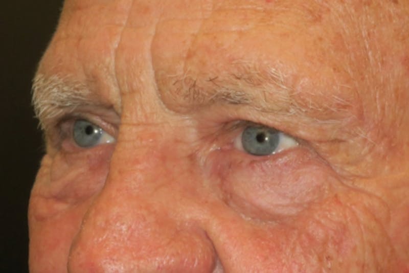 Upper Blepharoplasty (Upper Eyelid Surgery) Before & After Gallery - Patient 217597 - Image 6