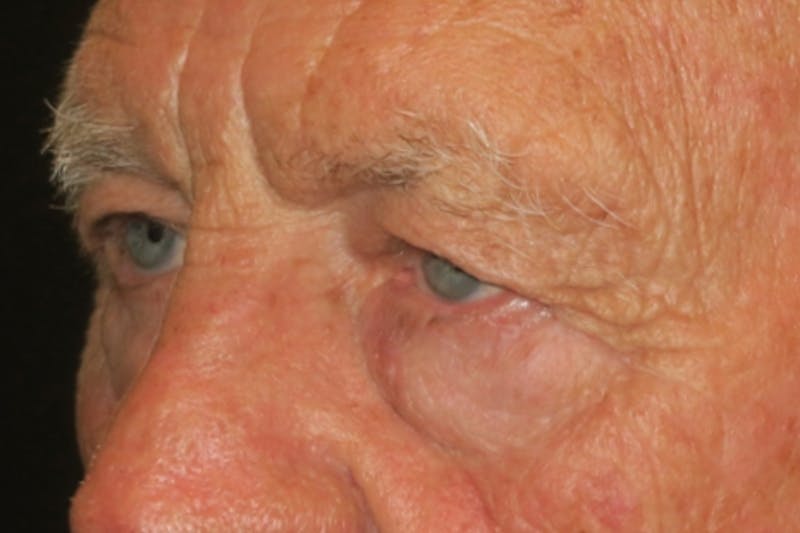 Upper Blepharoplasty (Upper Eyelid Surgery) Before & After Gallery - Patient 217597 - Image 3