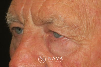 Upper Blepharoplasty (Upper Eyelid Surgery) Before & After Gallery - Patient 217597 - Image 3