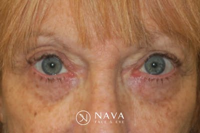 Upper Blepharoplasty (Upper Eyelid Surgery) Before & After Gallery - Patient 220291 - Image 2