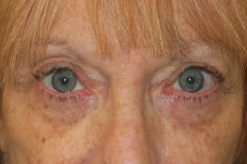 Upper Blepharoplasty (Upper Eyelid Surgery) Before & After Gallery - Patient 220291 - Image 2
