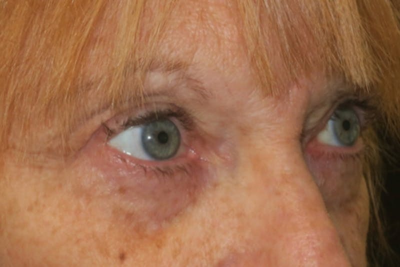 Ptosis Repair Before & After Gallery - Patient 312904 - Image 4