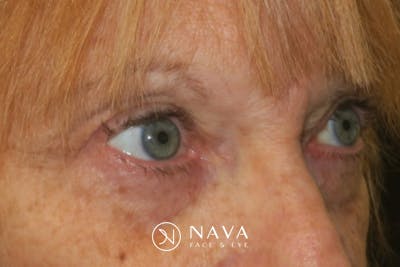 Upper Blepharoplasty (Upper Eyelid Surgery) Before & After Gallery - Patient 220291 - Image 4