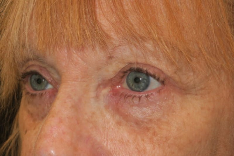 Upper Blepharoplasty (Upper Eyelid Surgery) Before & After Gallery - Patient 220291 - Image 6
