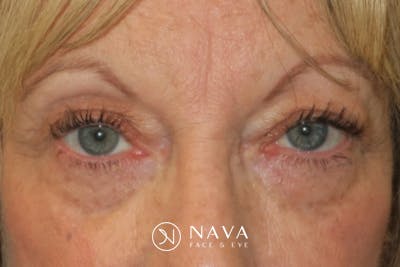 Upper Blepharoplasty (Upper Eyelid Surgery) Before & After Gallery - Patient 220291 - Image 1