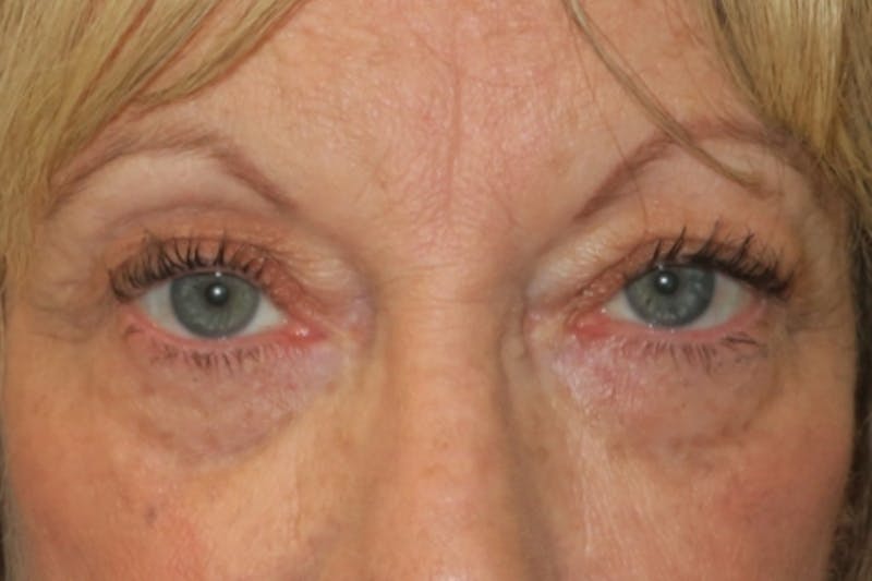 Upper Blepharoplasty (Upper Eyelid Surgery) Before & After Gallery - Patient 220291 - Image 1