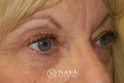 Upper Blepharoplasty (Upper Eyelid Surgery) Before & After Gallery - Patient 220291 - Image 3