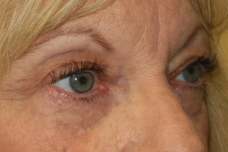 Upper Blepharoplasty (Upper Eyelid Surgery) Before & After Gallery - Patient 220291 - Image 3
