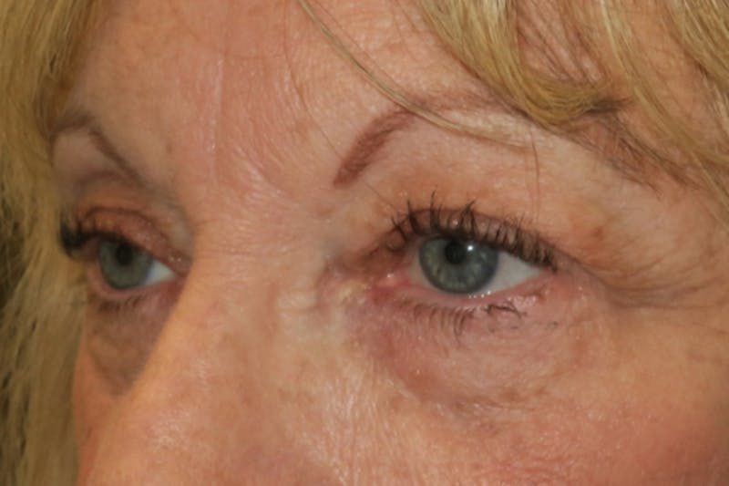 Ptosis Repair Before & After Gallery - Patient 312904 - Image 5