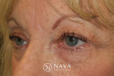 Upper Blepharoplasty (Upper Eyelid Surgery) Before & After Gallery - Patient 220291 - Image 5