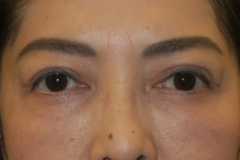 Ptosis Repair Before & After Gallery - Patient 133041 - Image 2