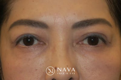 Asian Eyelid Surgery Before & After Gallery - Patient 139338 - Image 2