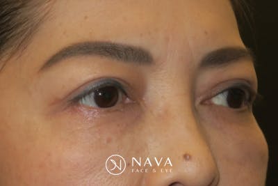 Asian Eyelid Surgery Before & After Gallery - Patient 139338 - Image 4