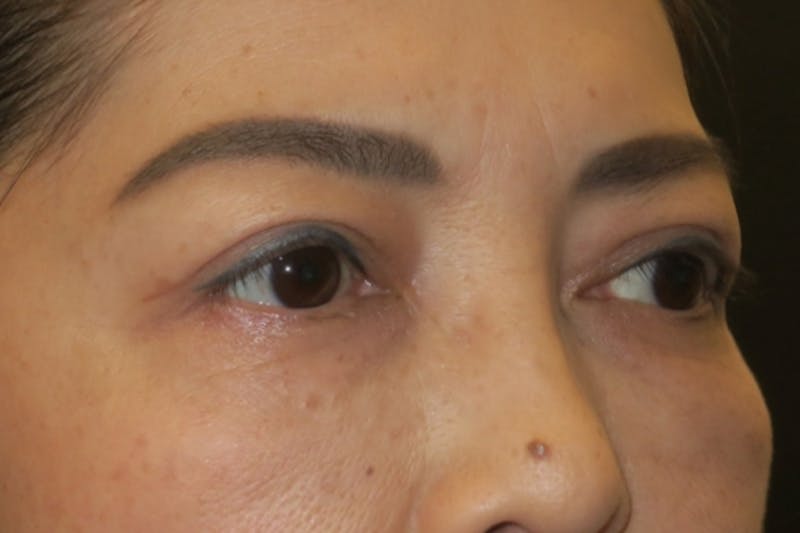 Ptosis Repair Before & After Gallery - Patient 133041 - Image 4