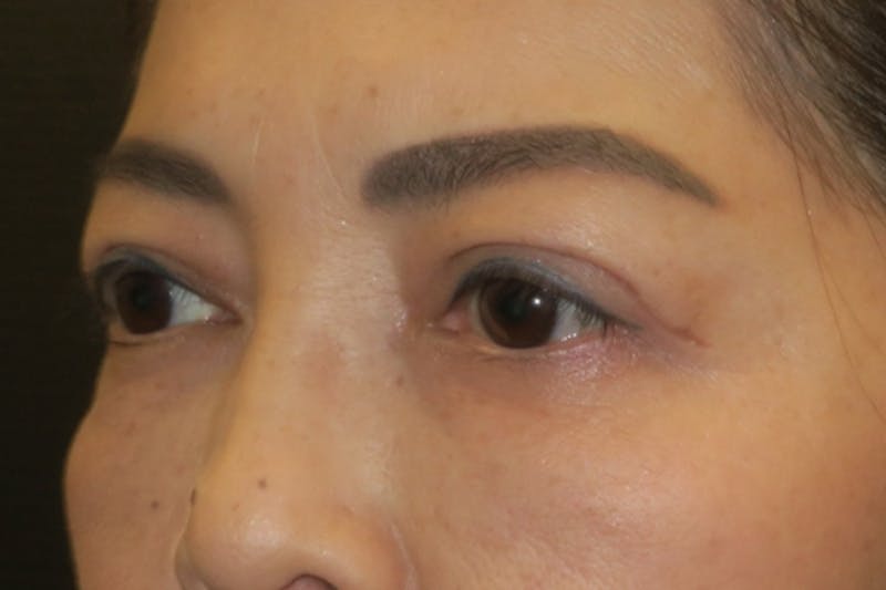 Ptosis Repair Before & After Gallery - Patient 133041 - Image 6