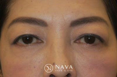 Asian Eyelid Surgery Before & After Gallery - Patient 139338 - Image 1
