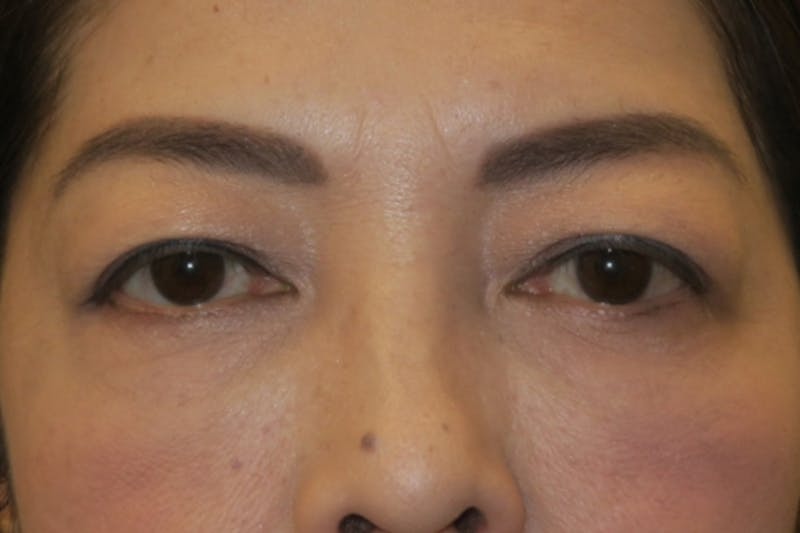 Asian Eyelid Surgery Before & After Gallery - Patient 139338 - Image 1
