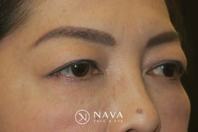 Asian Eyelid Surgery Before & After Gallery - Patient 139338 - Image 3