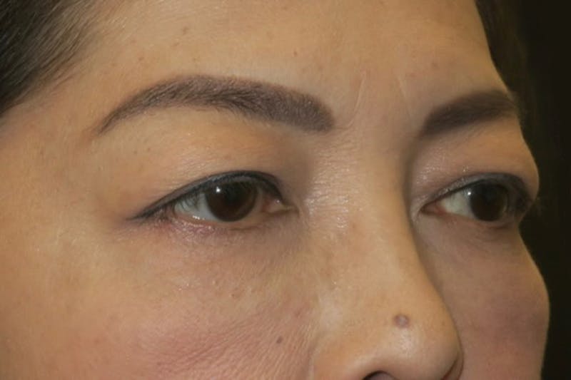 Asian Eyelid Surgery Before & After Gallery - Patient 139338 - Image 3