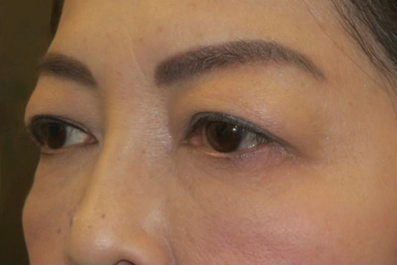 Ptosis Repair Before & After Gallery - Patient 133041 - Image 5