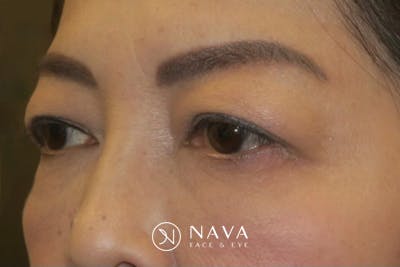 Asian Eyelid Surgery Before & After Gallery - Patient 139338 - Image 5