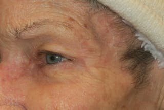 Mohs Reconstruction Before & After Gallery - Patient 144395 - Image 2