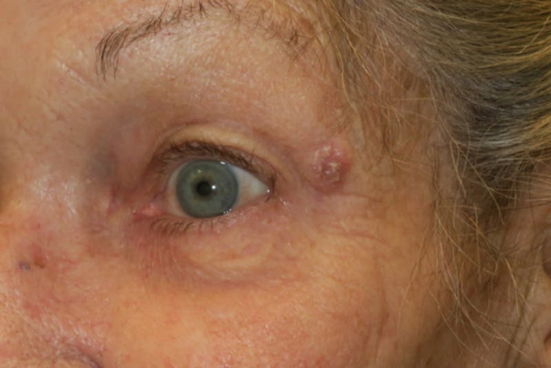 Mohs Reconstruction Before & After Gallery - Patient 144395 - Image 1
