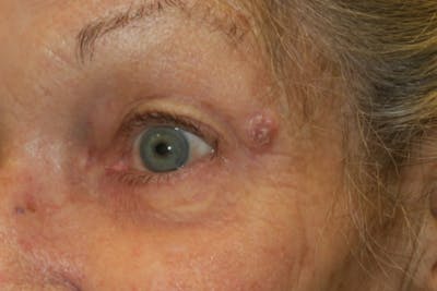 Mohs Reconstruction Before & After Gallery - Patient 144395 - Image 1