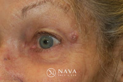 Mohs Reconstruction Before & After Gallery - Patient 144395 - Image 1