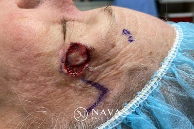 Mohs Reconstruction Before & After Gallery - Patient 144395 - Image 3