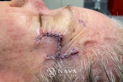 Mohs Reconstruction Before & After Gallery - Patient 144395 - Image 4