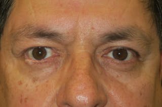 Mohs Reconstruction Before & After Gallery - Patient 369663 - Image 2