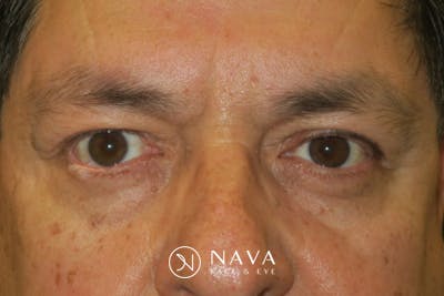 Mohs Reconstruction Before & After Gallery - Patient 369663 - Image 2